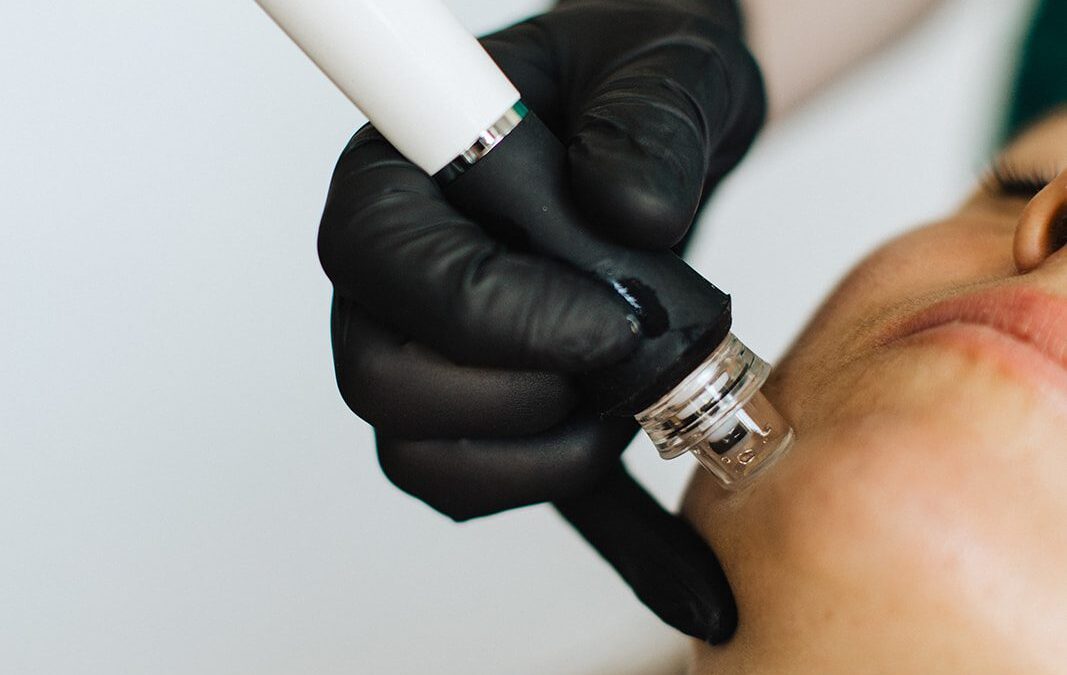 Revitalize Your Skin with the Magic of Microneedling