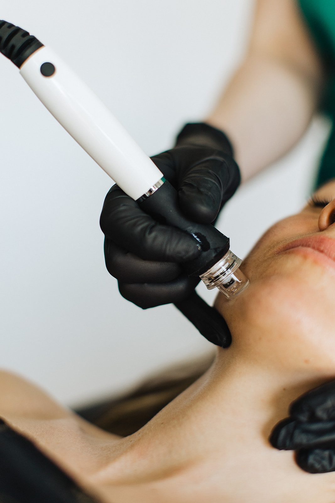 A woman receives medical microneedling.
