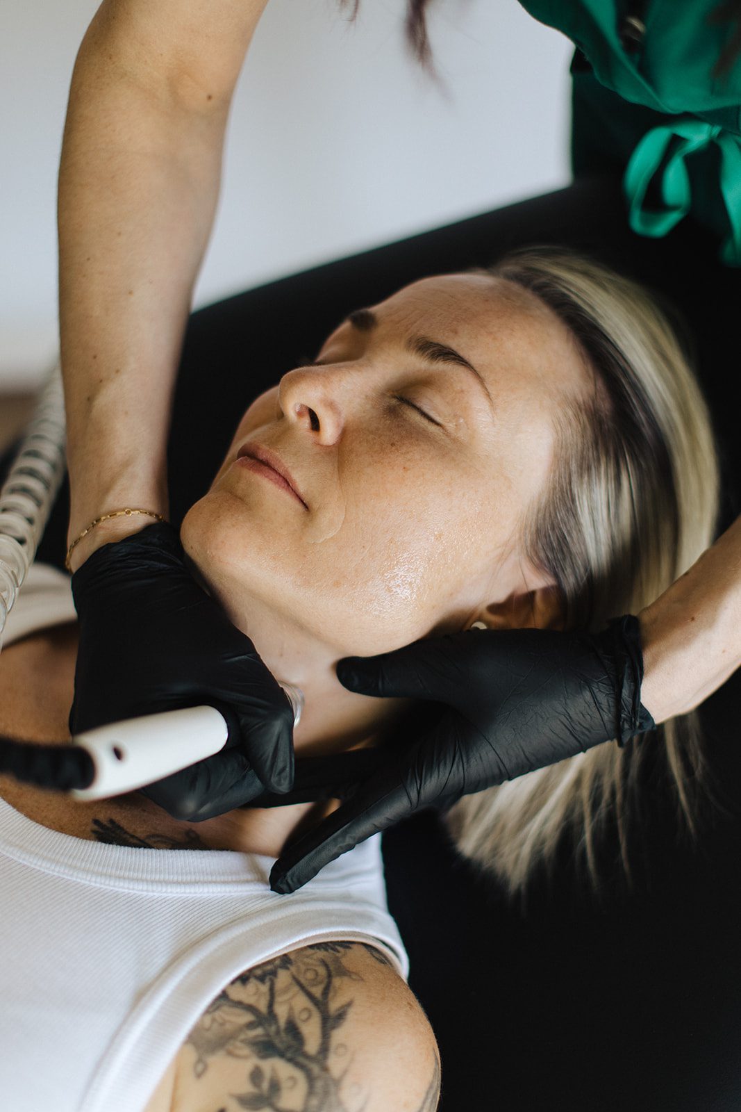 microneedling patient in Kelowna